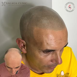 Discreto e perfeito! Esse é o resultado da micropigmentação capilar ✔️

Campeão em Micro Capilar 🏆
