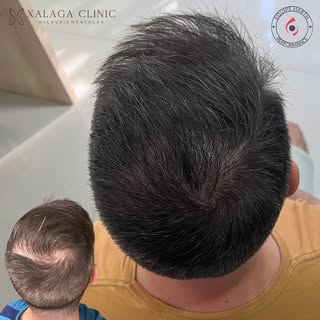 Saiba como se livrar da calvície de uma forma bem simples! ✅

Campeão em Micro Capilar 2022 🏆

Micr