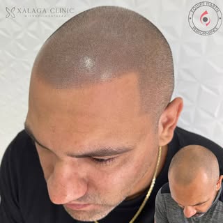 Discreto e perfeito! Esse é o resultado da micropigmentação capilar ✔️

Campeão em Micro Capilar 🏆
