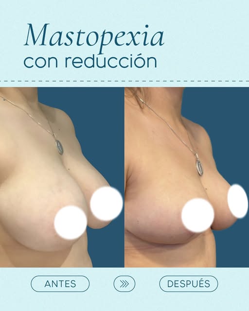 Menos peso, mejor posición y una forma mucho más armónica. ✨

La mastopexia con reducción mamaria pu