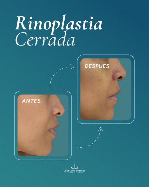 Una rinoplastia bonita no debería gritar: “me operé la nariz”. 🤍

Debería hacer que mires el rostro