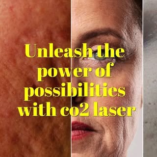 Revitalize your skin with the power of fractional CO2 laser! Say goodbye to imperfections and hello 