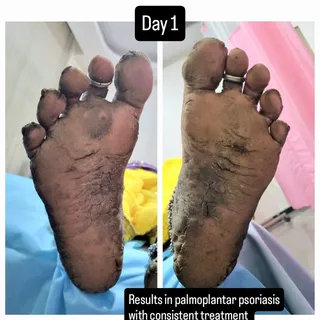 Palmoplantar psoriasis is an autoimmune condition characterized by excessive skin thickening and fis