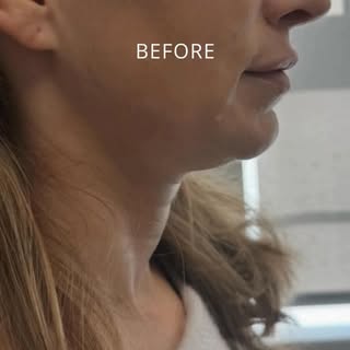 This patient came in looking to improve the neck and submental area. Dr. Blake Brooks developed a cu