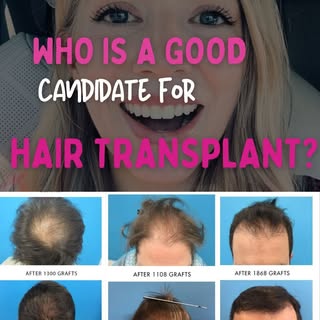 Who is a good candidate for hair transplant? 

I’m out speaking with our fantastic salon and barber 