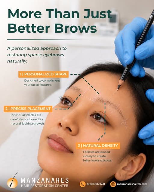 Sparse eyebrows caused by overplucking, genetics, alopecia, or scarring can be restored through an e