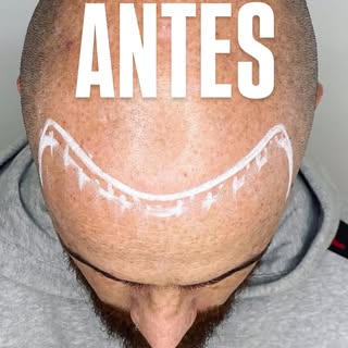 ANTES ➡️ DESPUÉS 🔥

Un cambio que no necesita filtros. Una micropigmentación capilar en Benalmádena