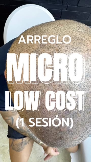 Ojo cuando una micro low cost sale mal…
Antes, pigmentación azulada con grandes “blowouts” y un dise