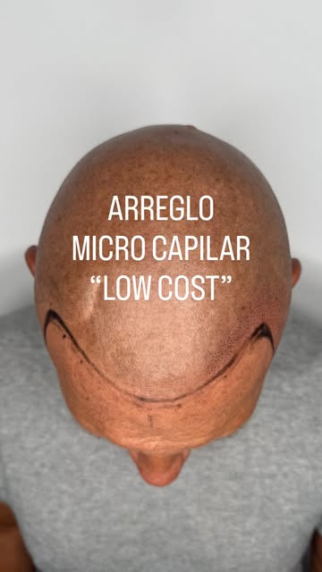 🔴 De micro low cost a un resultado mucho más natural. Antes y después real en una sola sesión. 👌✨ 