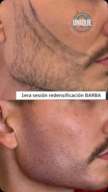 🧔🏻‍♂️✨ Aquí podemos ver el antes y el después de una micropigmentación de barba… 

El objetivo no 