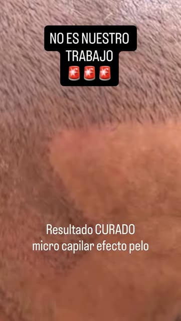 Muchas son las consultas que nos llegan solicitando una micro capilar “efecto hilo o pelo” como suel
