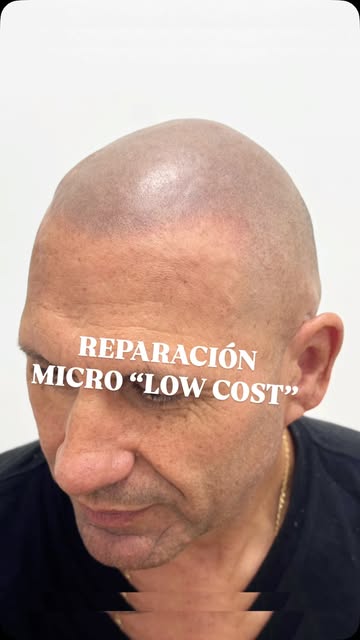 Segunda sesión de reparación de una micropigmentación low cost…

En estas fotos no hay filtros, no h