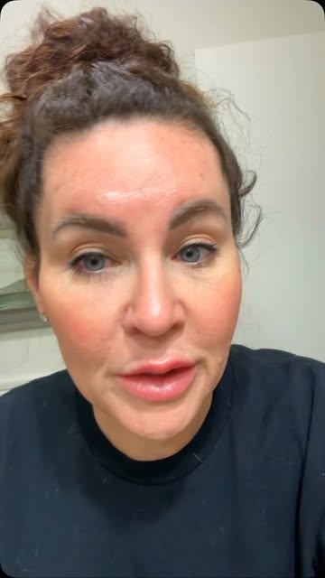 Decided to have my pmu brows lasered off to be able to start over eventually. The color has been wro