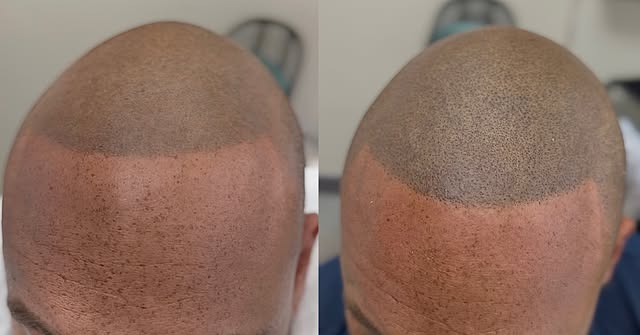 5 years after his original Scalp Micropigmentation procedure, this gentleman wanted more texture, de