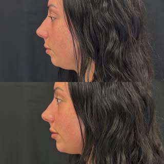 Everyone talks about lips, but let’s not sleep on the chin! 👏 

Chin filler = underrated game chang