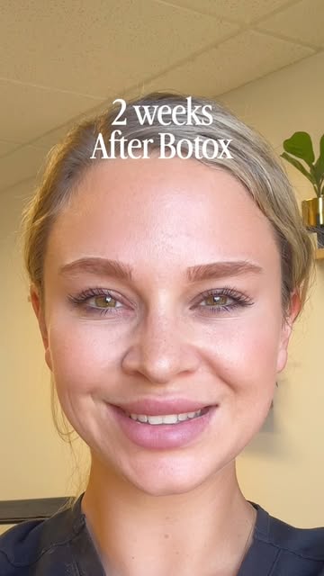 Same expressions. Smoother lines. ✨

Botox results across the forehead, glabella + crow’s feet — sof