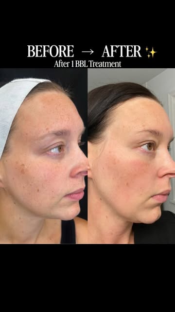 She trusted her sister with the laser 😏⚡️

✨ Results after ONE BBL treatment ✨
BBL targets unwanted