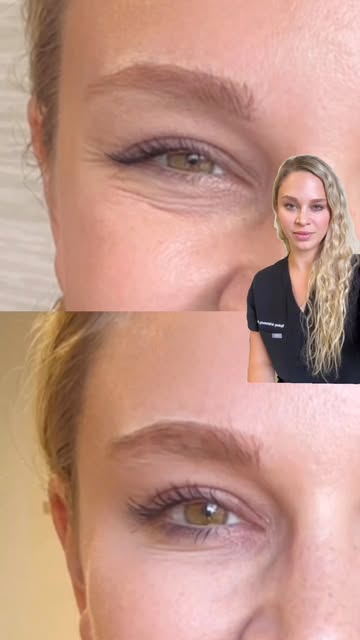 You’ve seen the before & after—here’s the muscle behind the magic 💉✨

Breaking down how Botox softe