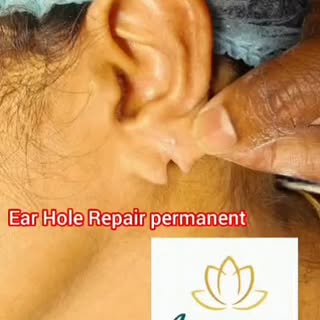 #ameyaaclinic ,#lobuloplasty ,#ear hole repair