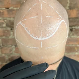 Which hairline you rocking 🎸 ? #smp #scalpmicropigmentation #hairloss #balding #microneedling #hair