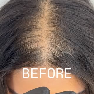 Ladies feel the CONFIDENCE,there no more hiding under a 🎩 

#scalpmicropigmentation #micropigmentat