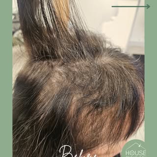 Wow 😮

What amazing results for my client who came in only 4 MONTHS AGO with acute Telogen Effluviu
