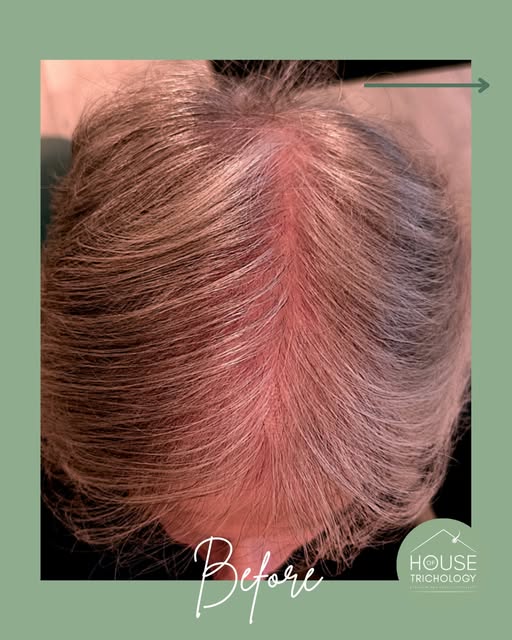 Here is one of my patients progress so far…

Already, we can see their hair is fuller with a big jum