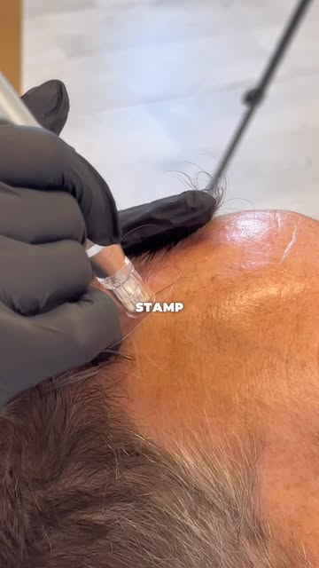 Microneedling… Sounds scary right?

This is a service I offer that not many people know about, but i