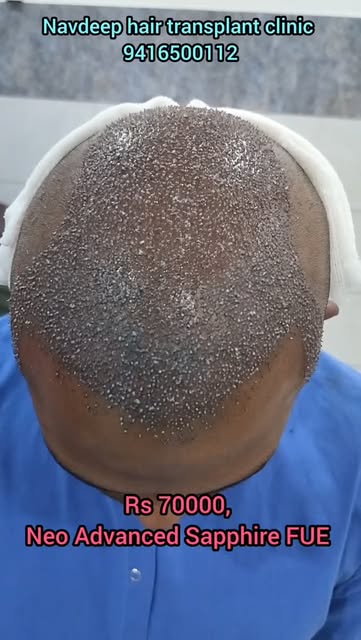 Get 100% Natural Hair Density with Advanced Neo Sapphire FUE!
Say goodbye to hair loss and restore y