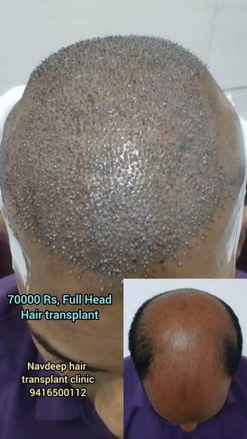 Transform your look and regain your confidence! Watch this full head hair transplant performed for N