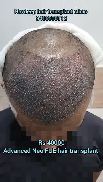 Is a hair transplant truly permanent?
Dr. Navdeep Goyal (MBBS, DNB) explains how transplanted hair i
