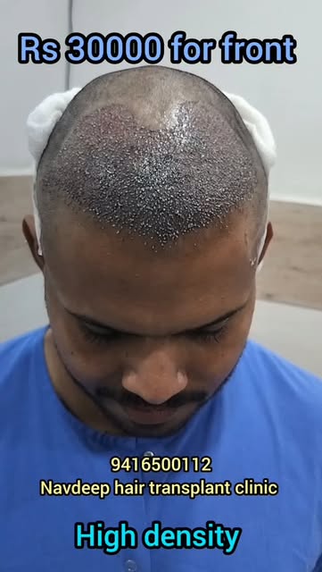 Experiencing hair fall 2 to 6 weeks after your hair transplant? Don’t panic—this is the completely n