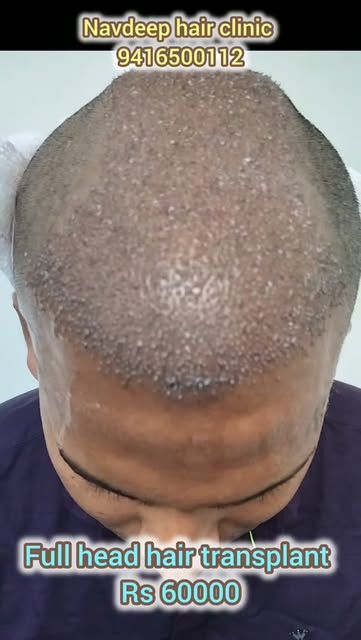 Transform your hairline with natural, dense, and permanent results!
Get a Full Head Hair Transplant 