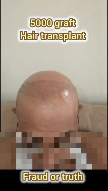 5000 Grafts या बड़ा Fraud? 😱
इस मरीज से ₹85,000 लिए गए और दावा किया गया कि 5,000 ग्राफ्ट्स लगाए गए 