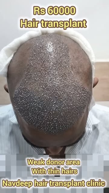 Transforming thin hair and limited donor areas into natural, high-density results is possible with t