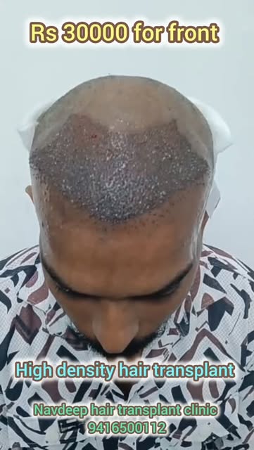 Get natural, high-density hairline results at an unbeatable price! Watch this frontal hairline trans