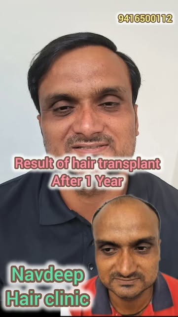 Incredible 1-Year Hair Transplant Results! ✨
Front area hair transplant starting at just ₹30,000! Lo