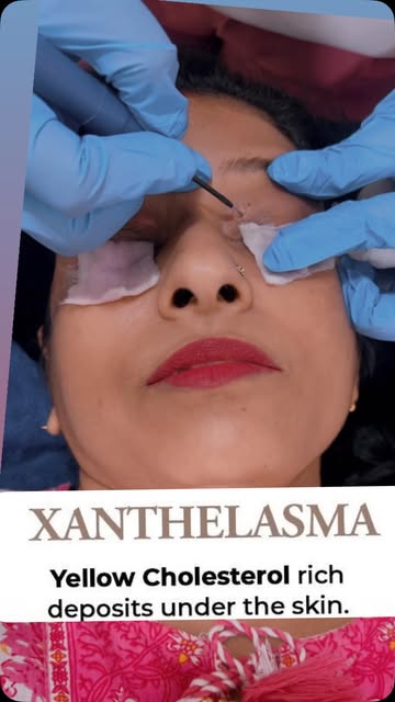 👁️ Xanthelasma Removal
🩺 Cosmetic Minor Procedure
✨ Precision • Care • Aesthetic Results
Non surgi