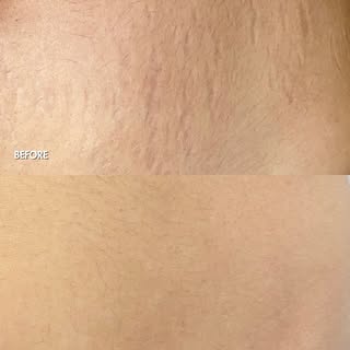 Results after just 2 sessions! FraxPro laser is one of the most effective treatments for stretch mar