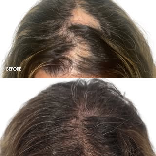 Scarring hair loss treated with a hair transplant, 5 months ago. Life changing results that will con