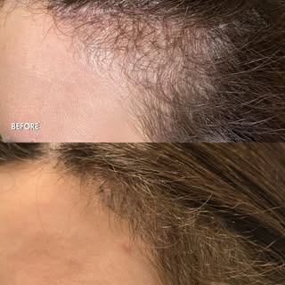 Results 5 months after hair transplant for temple hair thinning in woman. 
#hairtransplantation
#der