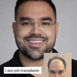 Uma transformação que impressiona 1 ano pós cirurgia. O verdadeiro transplante capilar não é aquele 