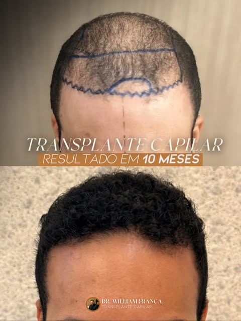 ✨ 10 meses podem transformar uma história.

Neste resultado de transplante capilar, mostramos a evol