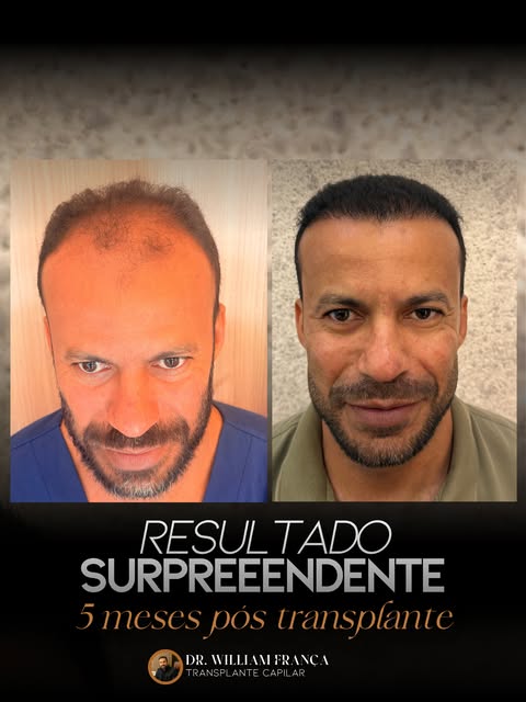 ✨ A evolução está nos detalhes.

O transplante capilar é um processo que exige planejamento, técnica