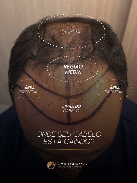 🧑‍⚕️ Você sabe em qual região a queda de cabelo está mais evidente?

A calvície pode se manifestar 