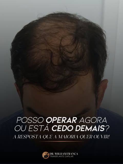 “Com quantos anos posso fazer um transplante capilar?” 🤔

A resposta é: depende — e não apenas da i