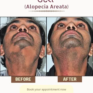 Alopecia areata is an auto immune condition. Its treatment is quite different from the general #hair