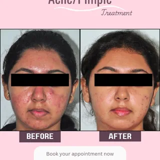 Proof that consistent care delivers results! ✨ #Acne doesn't stand a chance at WhiteInk Skin and Las