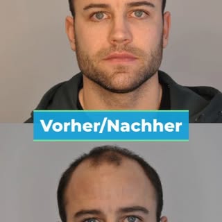 Ein weiteres Ergebnis einer erfolgreichen Haartransplantation 😎