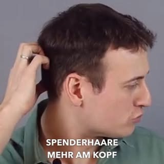 Körperhaare für eine Haartransplantation? So geht's.